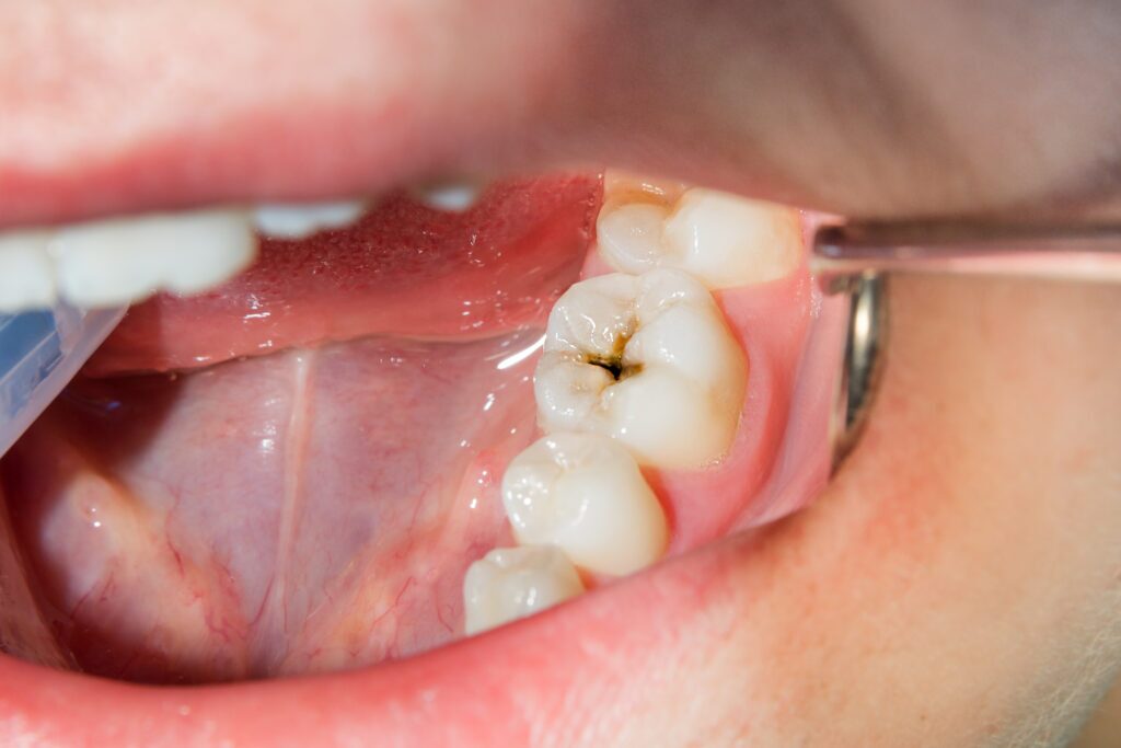 Tooth with an untreated cavity.