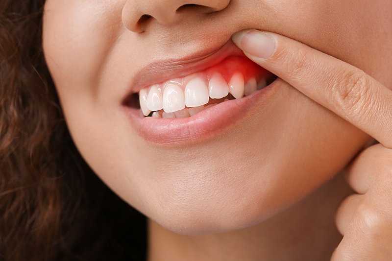 Close-up of inflamed red gums being examined, illustrating common symptoms of gingivitis treated at O2 Dental Group.