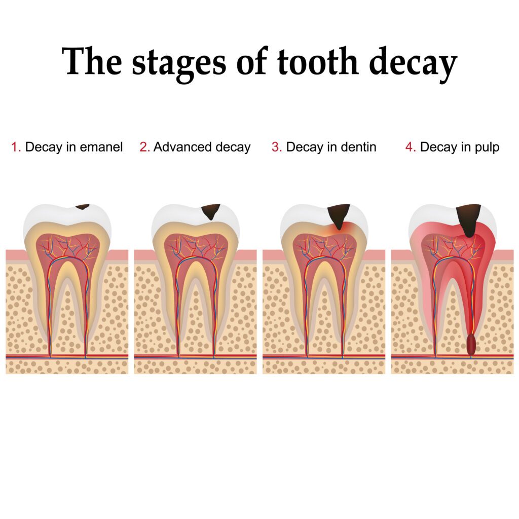 Image of dental caries (tooth decay) formation step by step, forming dental plaque and finally caries and cavity.