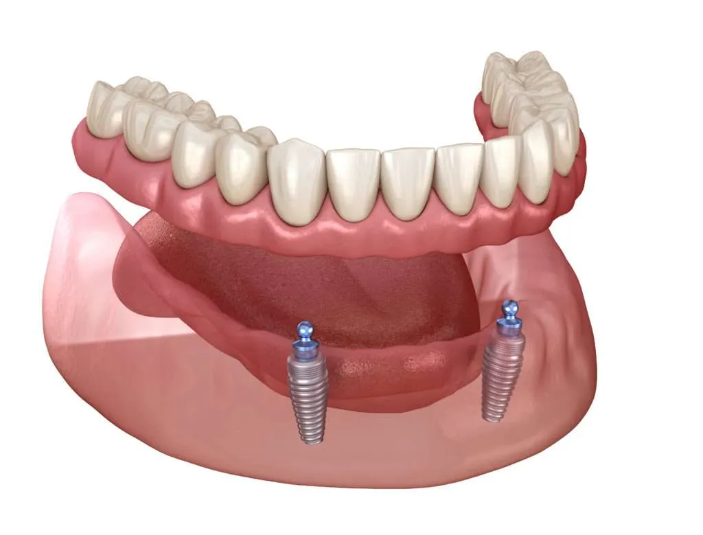 Illustration of a lower implant-supported denture snapping onto two dental implants for secure stabilization.