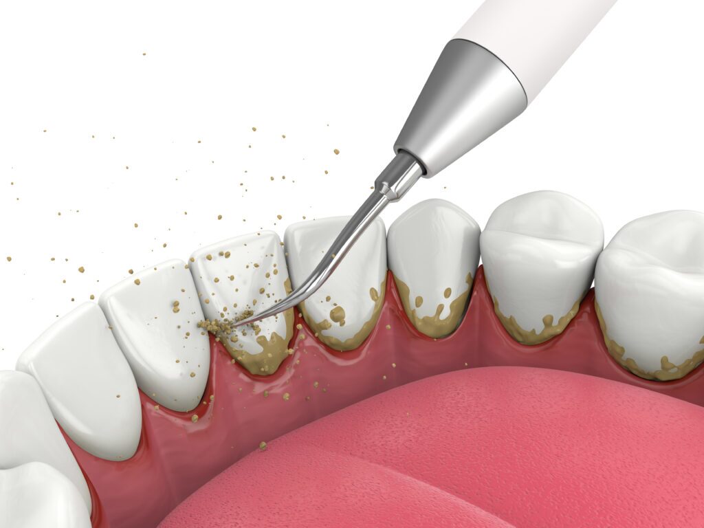 Rendering of removing plaque from teeth with an ultrasonic descaler.