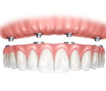 Implants-w-dentures-300x203-1