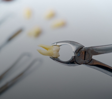 Tooth Extraction