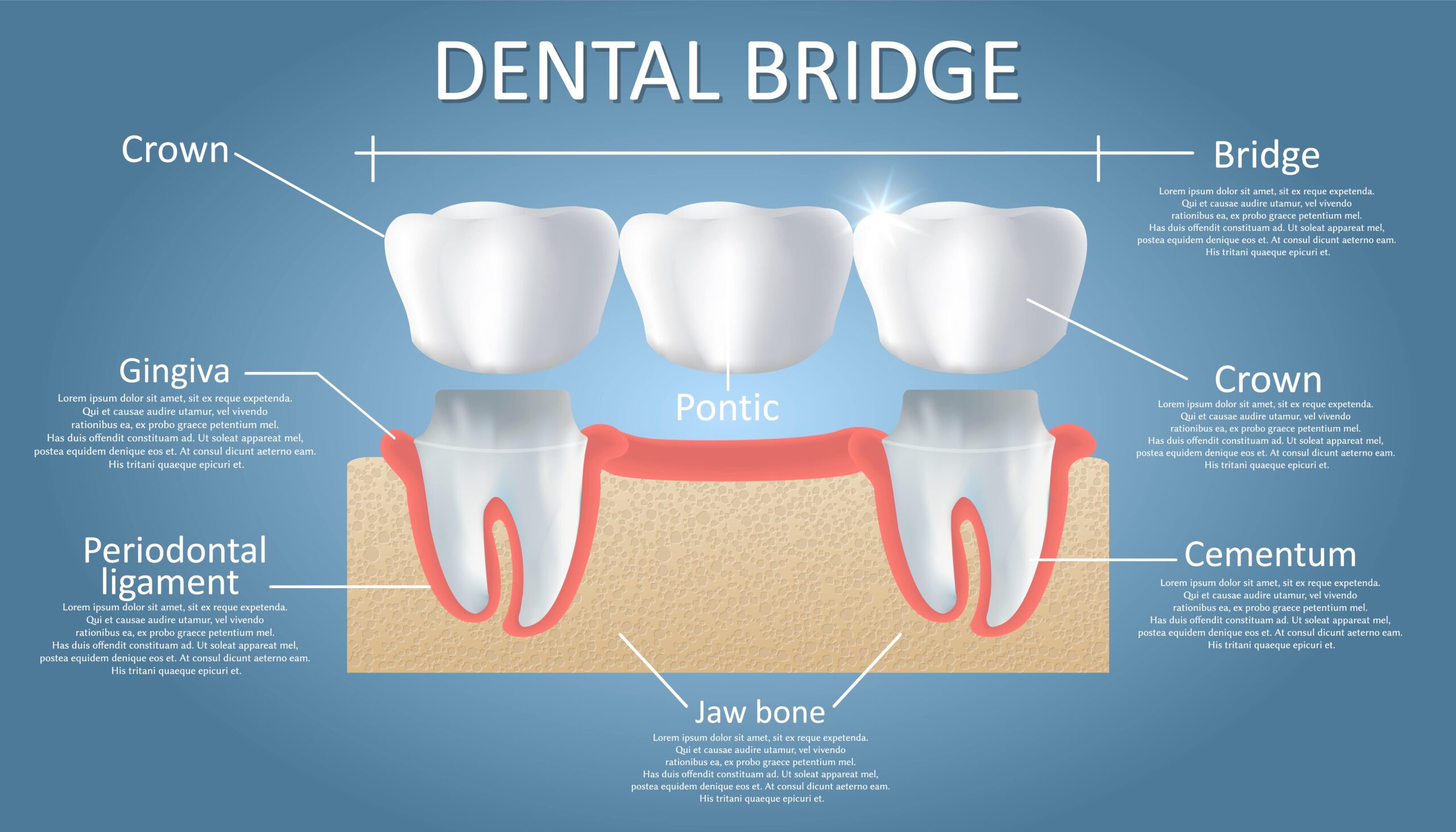 Dental Bridges