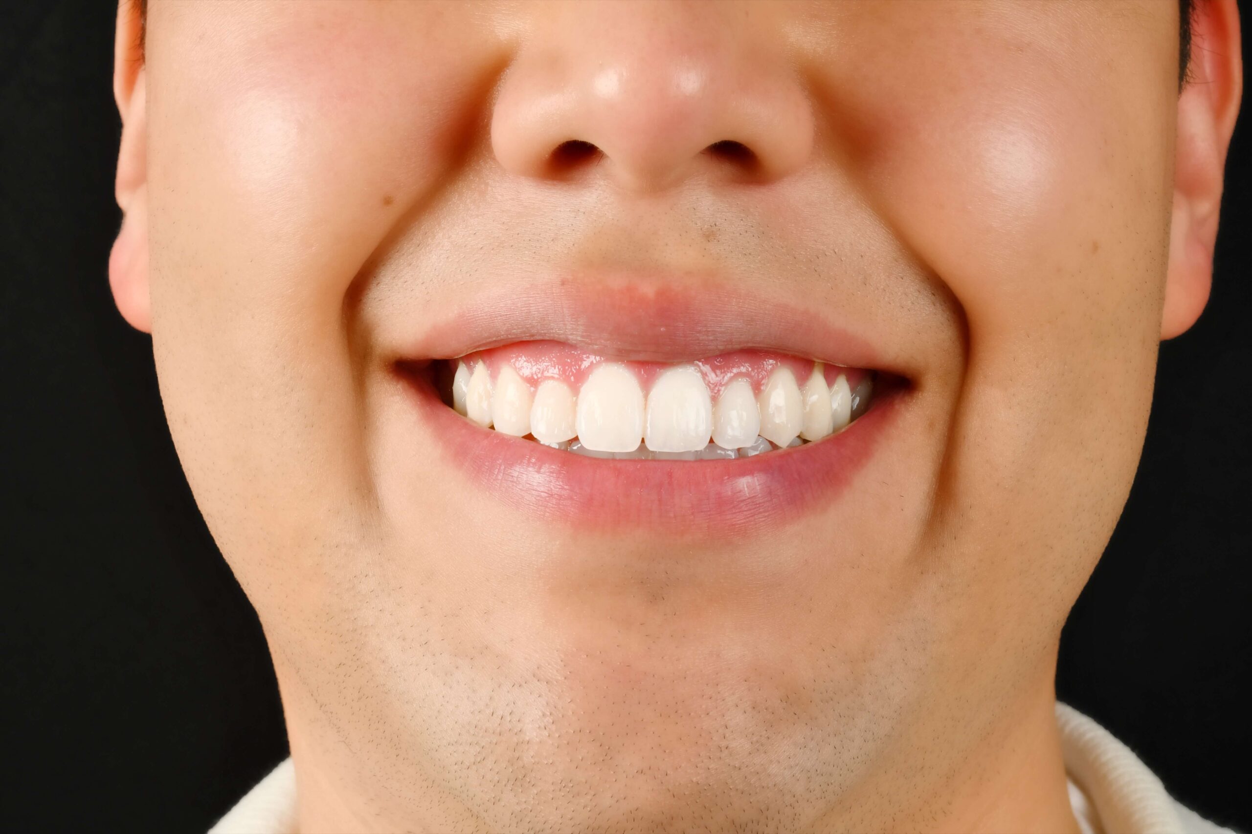 Invisalign