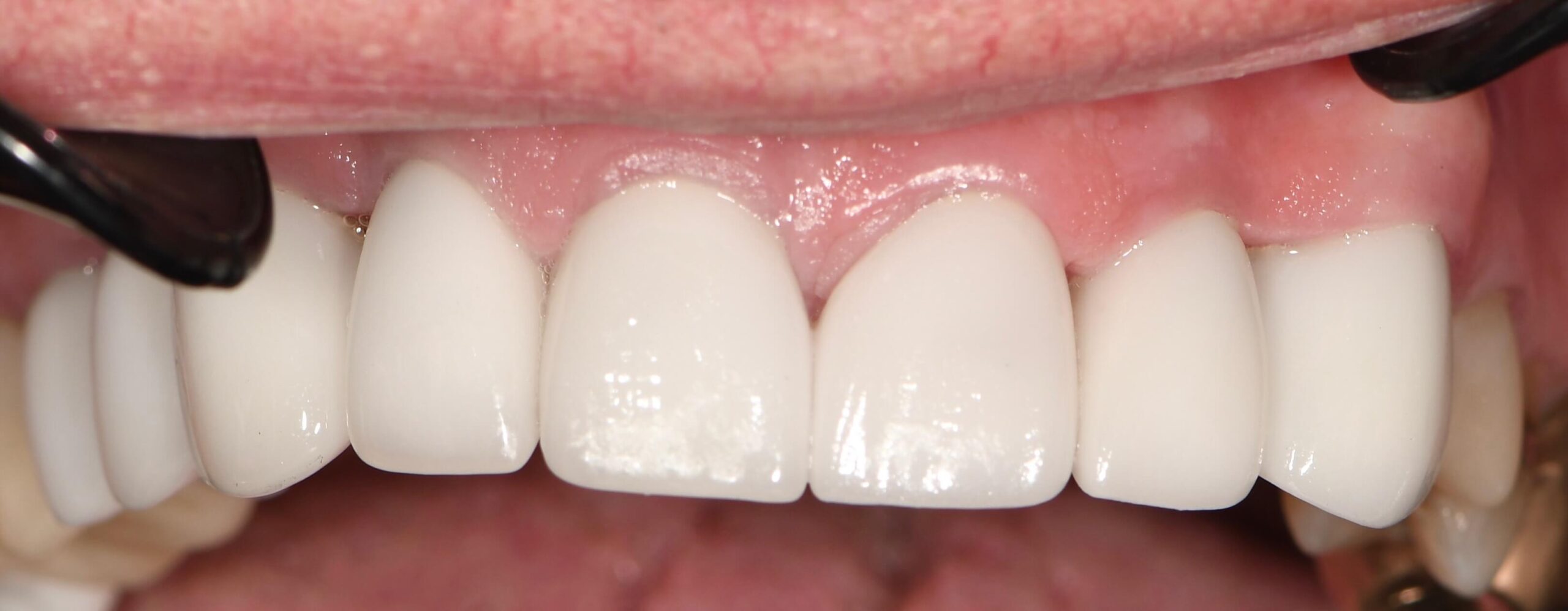 Close-up of restored teeth with natural-looking crowns, representing a successful restorative "after" case at O2 Dental Group.