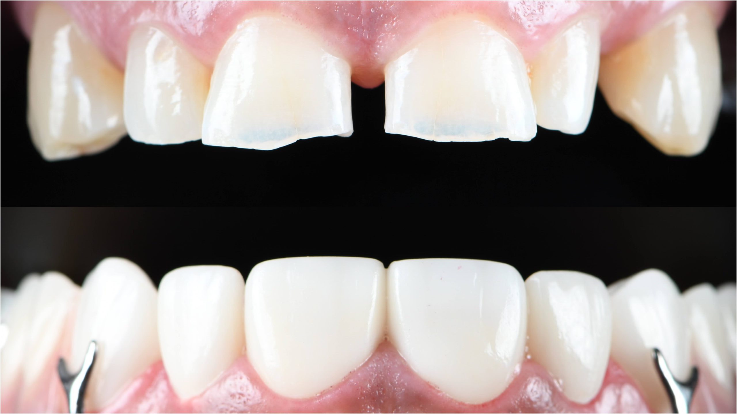 Dental Veneers
