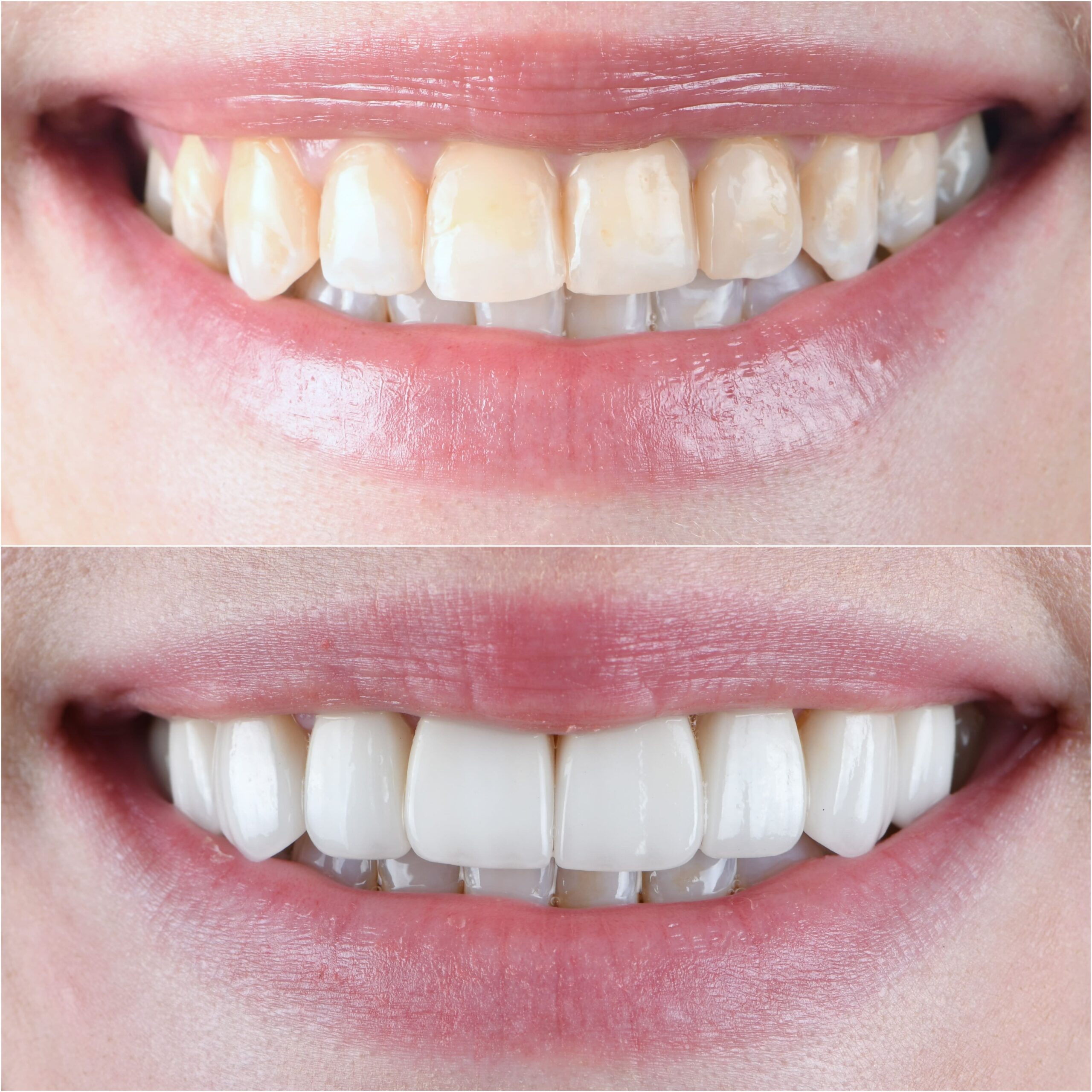 Dental Veneers