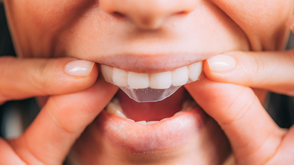 A person applying teeth whitening strips to the top row of their teeth.