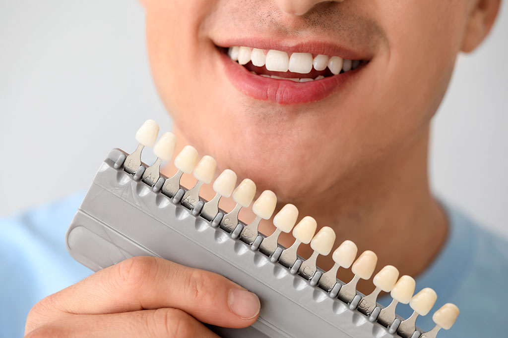A man with a brilliant bright smile after tooth whitening, holding up a sample of slightly yellowed veneer samples against the pure white of his.