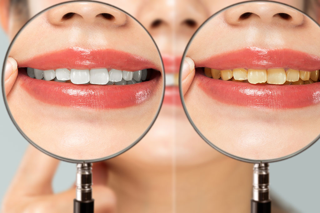 A side-by-side comparison of a woman’s mouth, with a magnifying glass over her smile, with the original yellow color on the right and a bright, beautiful, whiter smile on the right.
