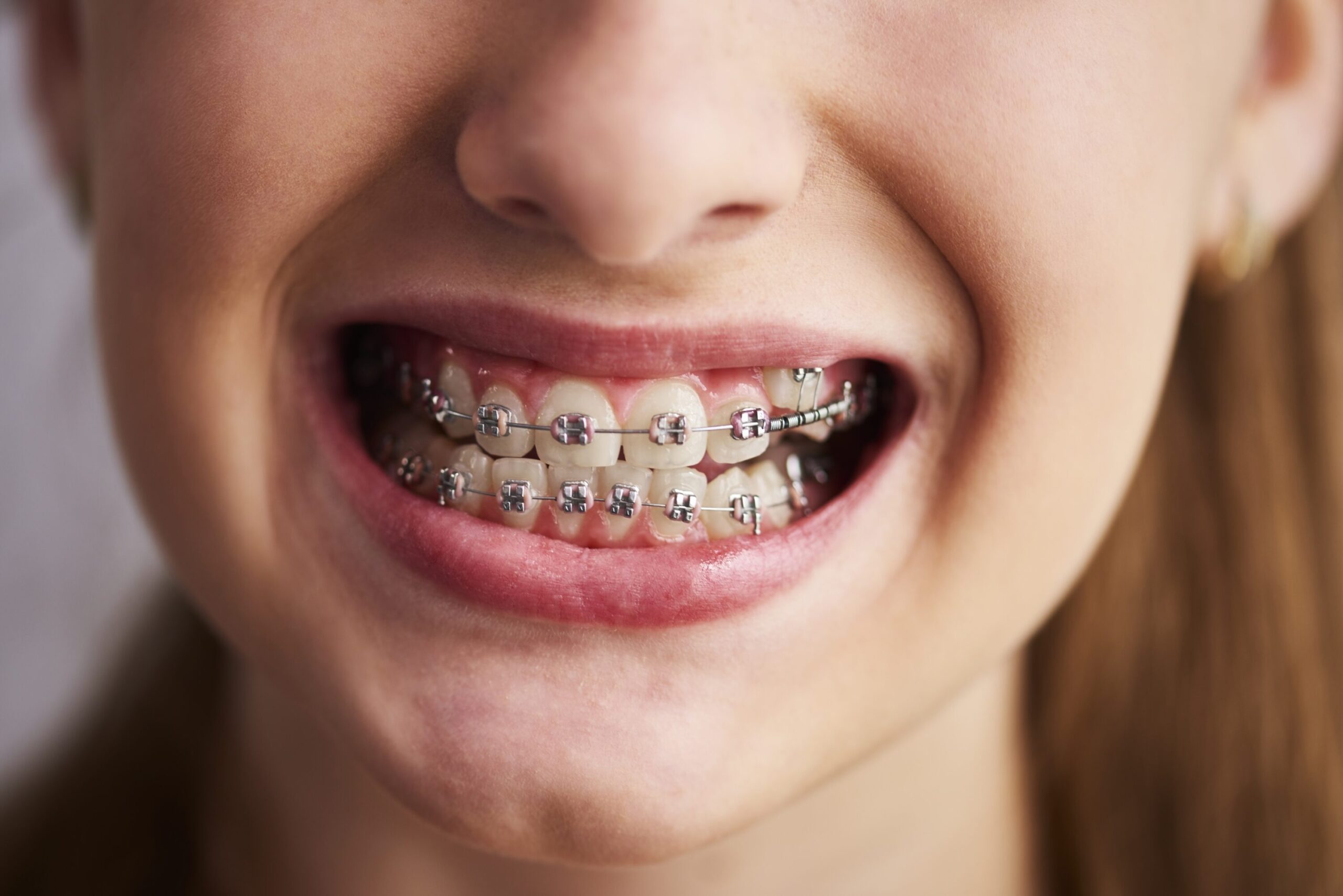6 Signs You Might Need Braces